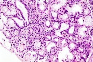 Sjögren syndrome