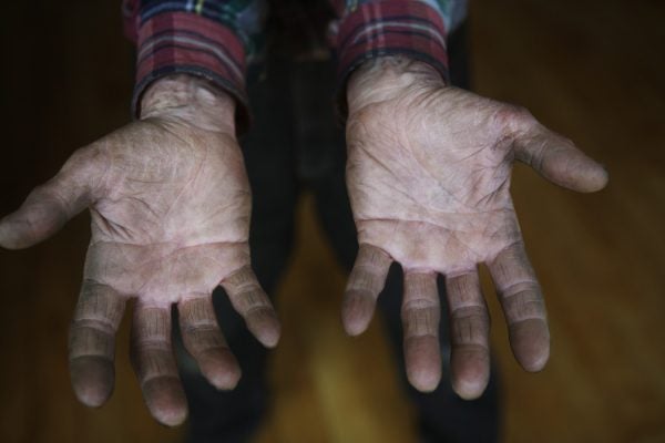 A person's palms presented to the camera