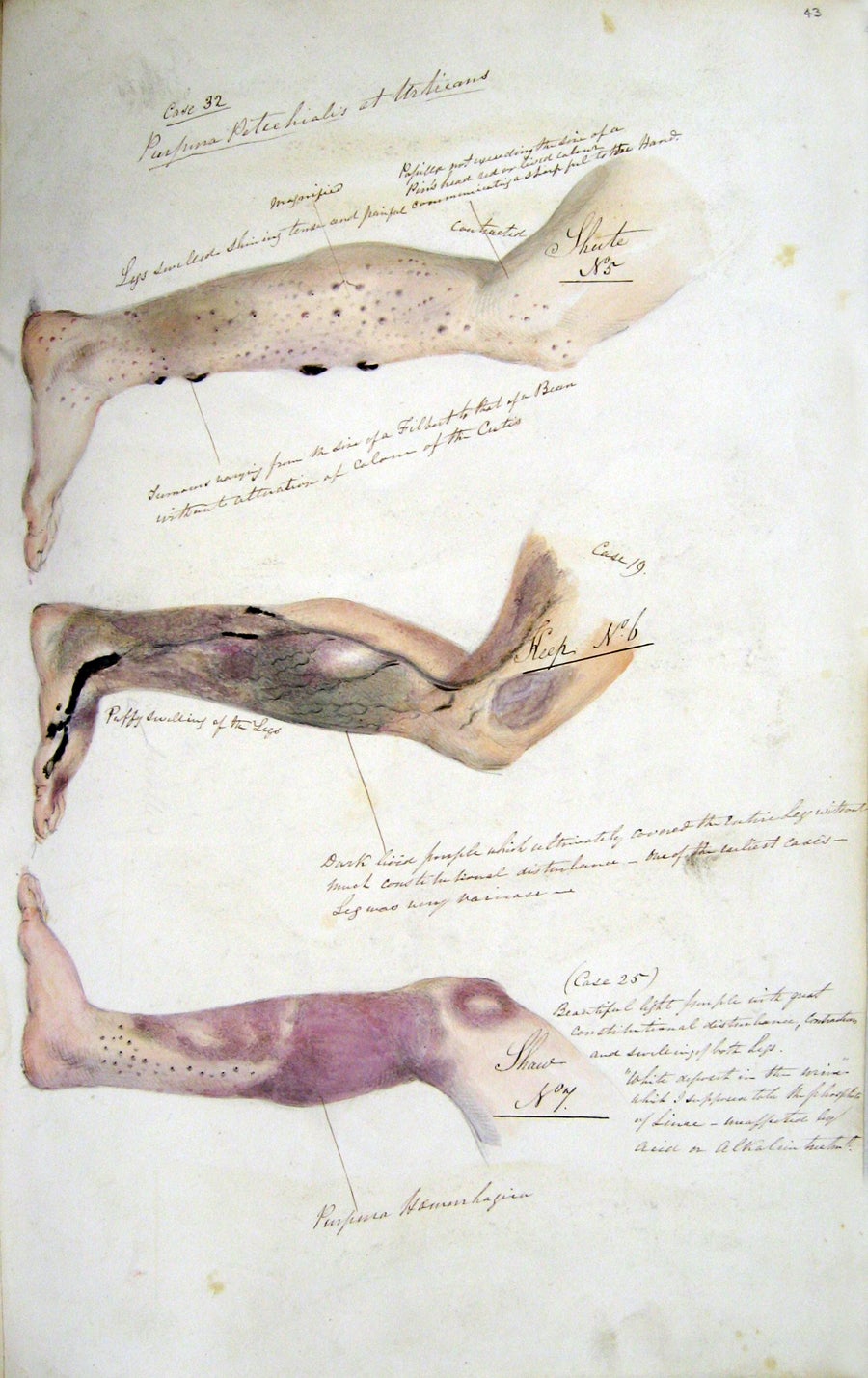 Page from the journal of Henry Walsh Mahon showing the effects of scurvy, from his time aboard HM Convict Ship Barrosa, 1841