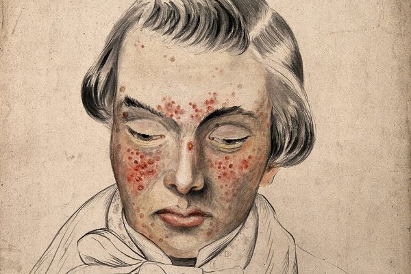 Illustration: Head of a man with a severe disease affecting his face by Christopher D' Alton, 1858

Source: https://www.jstor.org/stable/community.24834473