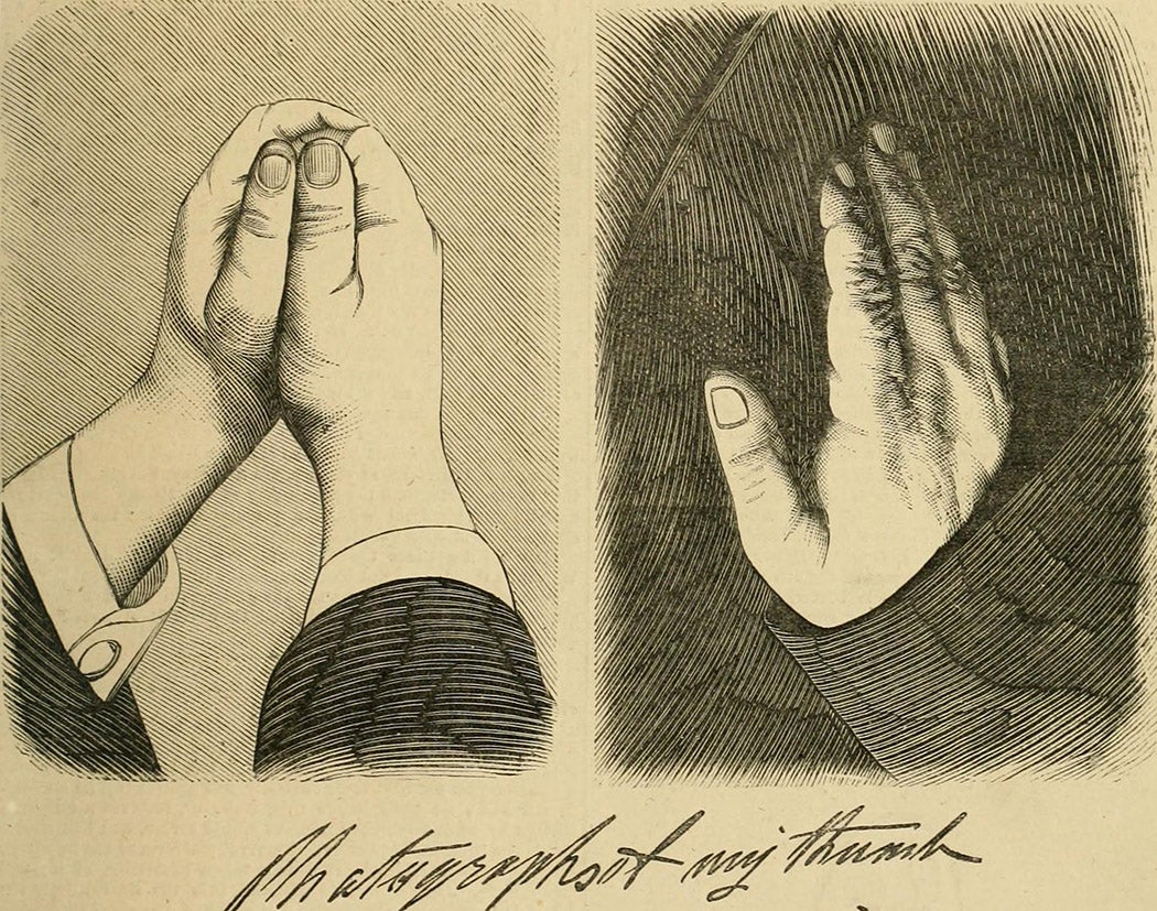 An illustration of Tichborne's thumb
