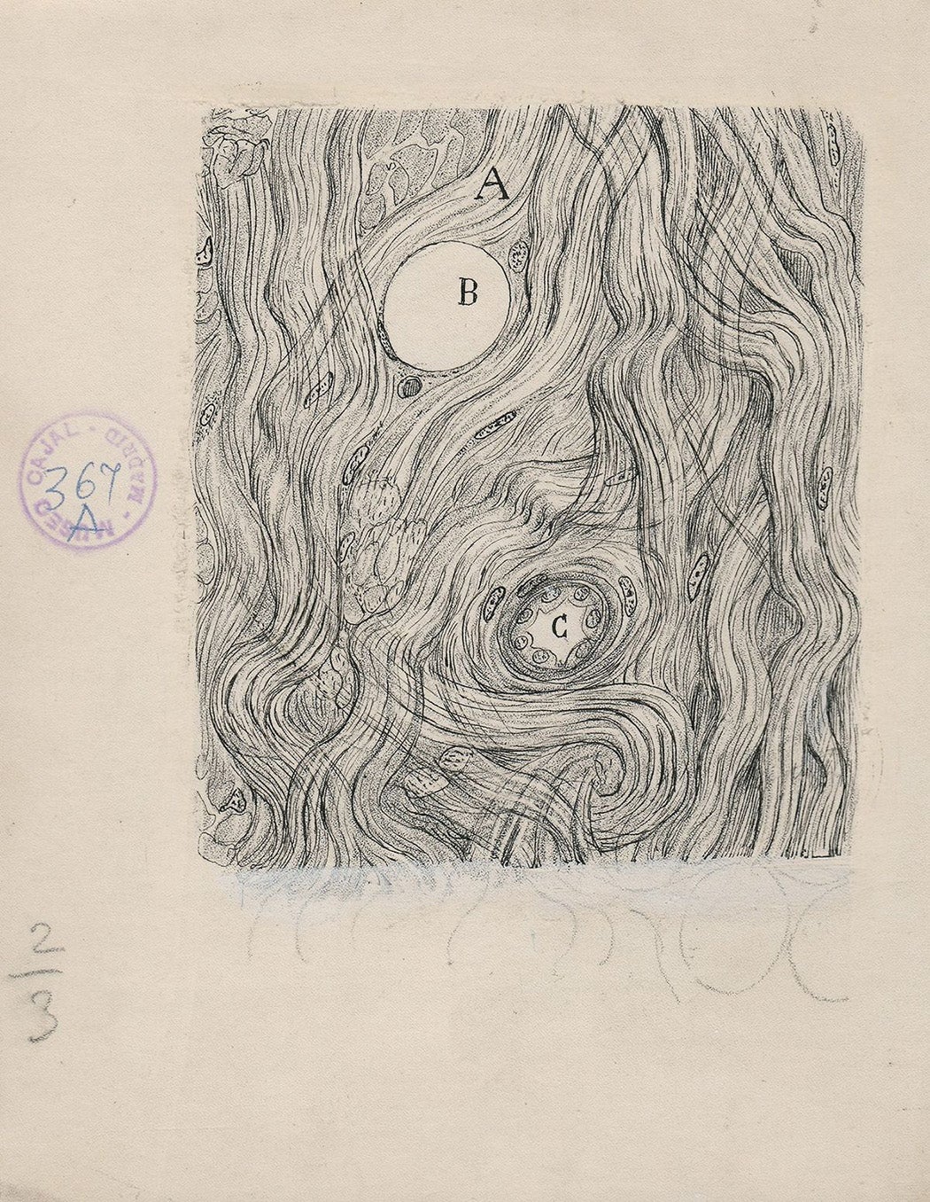 Illustration by Cajal of tumor cells of the covering membranes of the brain
